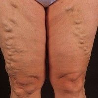 Varizen (Quelle: Dr. med. Samuel Zwicky-Smith Mac Donald). Varizen (Quelle: Dr. med. Samuel Zwicky-Smith Mac Donald).