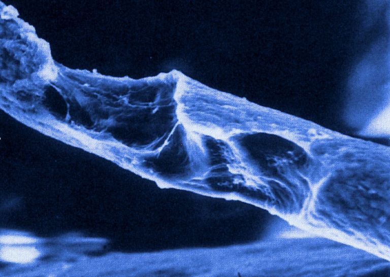 Knochen mit Osteoporose (zur Verfügung gestellt von Prof. Kurt Lippuner). Knochen mit Osteoporose (zur Verfügung gestellt von Prof. Kurt Lippuner).